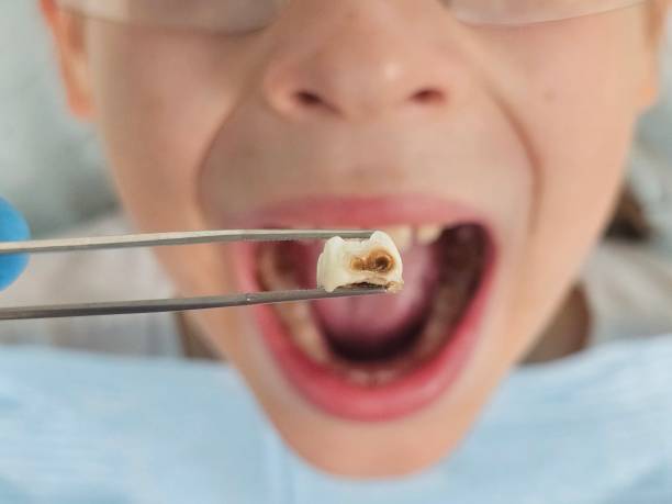Best Emergency Wisdom Tooth Extraction in Montague, CA